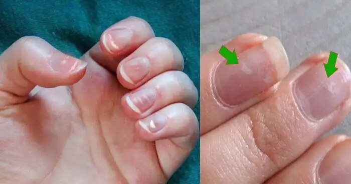 Understanding Nail Marks: Insights from Palmistry