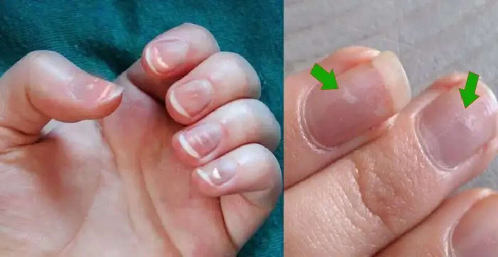 Understanding Nail Marks: Insights from Palmistry