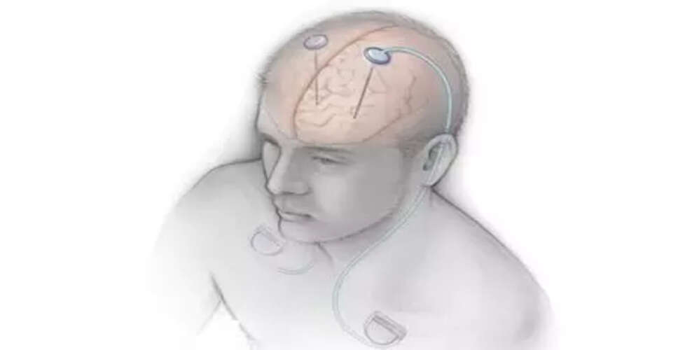 Pioneering Workshop on Deep Brain Stimulation for Parkinson's at AIIMS