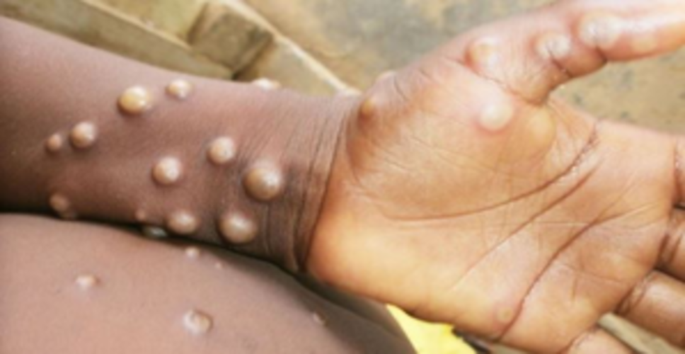 Cambodia reports 3 more cases of mpox