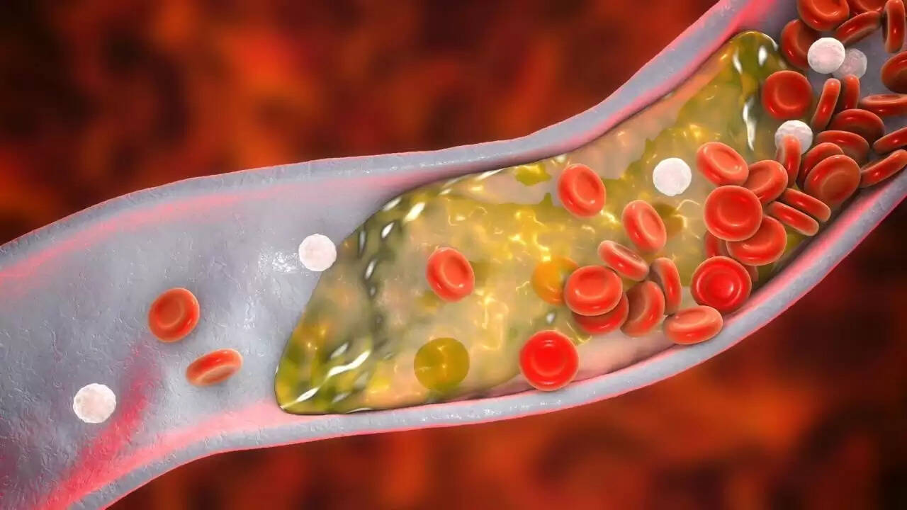 Understanding Heart Blockage: Causes, Symptoms, and Prevention