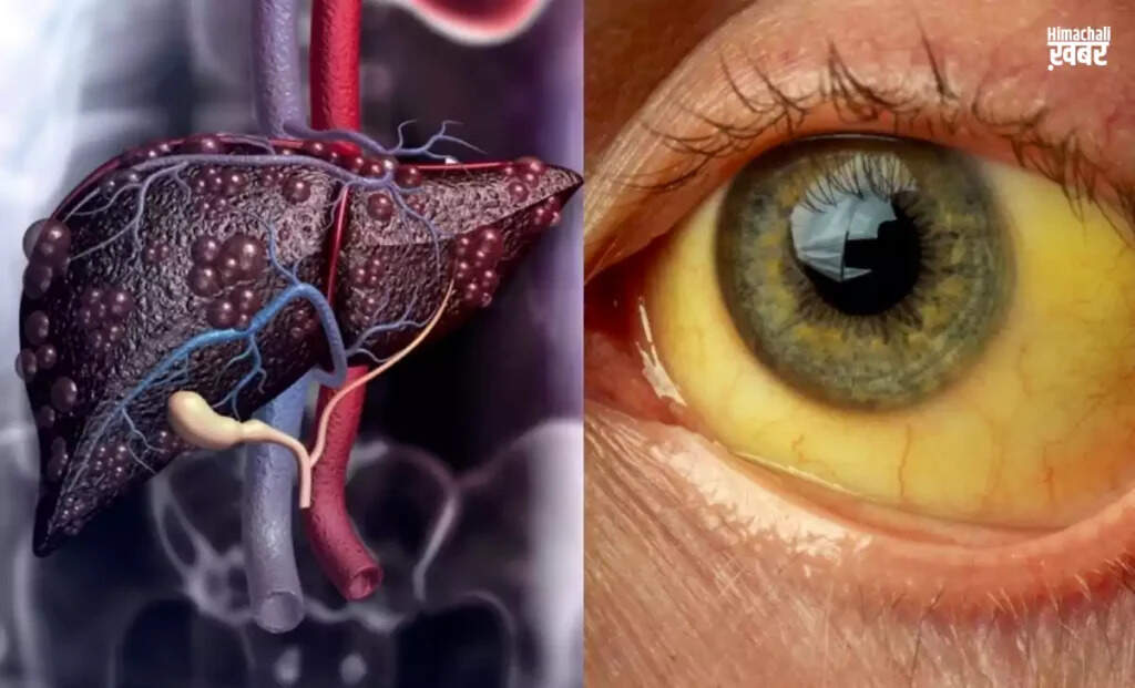 Understanding Liver Cirrhosis: Causes, Symptoms, and Prevention