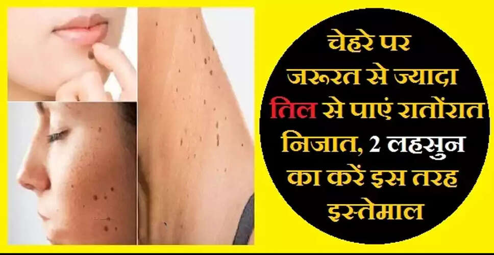 Effective Home Remedies to Remove Unwanted Moles