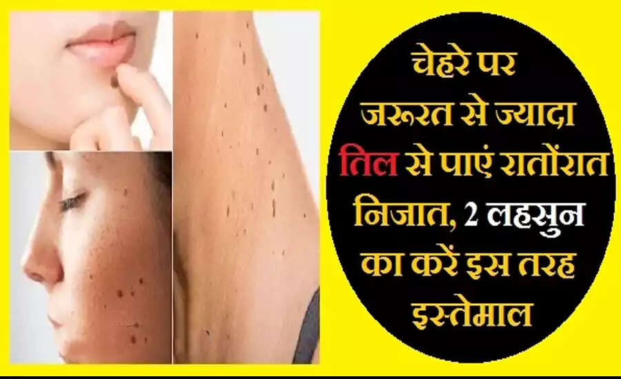 Effective Home Remedies to Remove Unwanted Moles