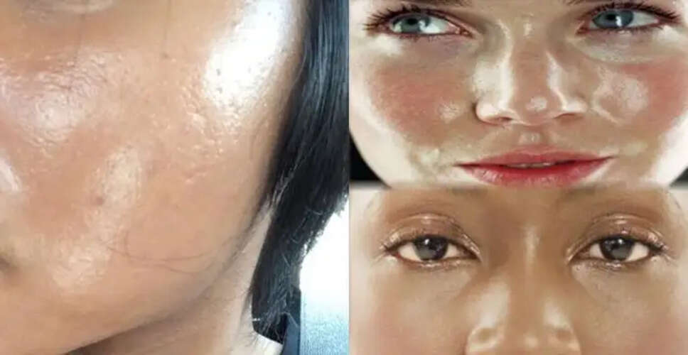 Effective Remedies for Oily Skin in Summer