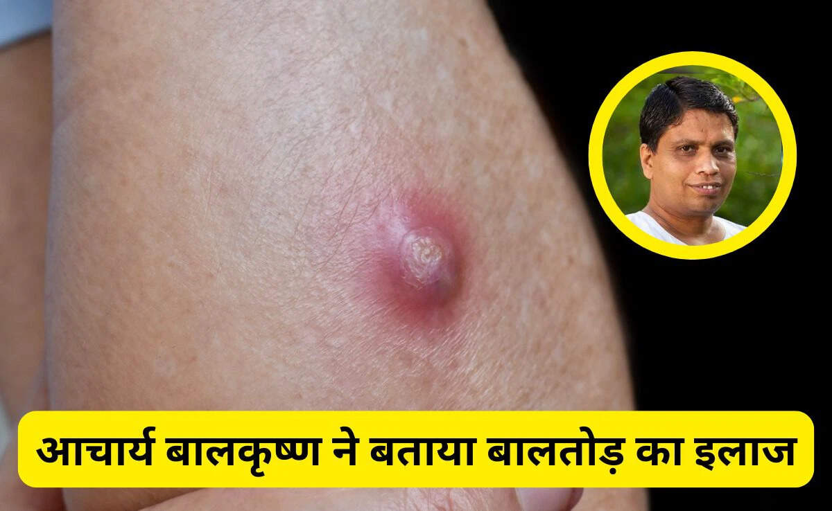 Effective Home Remedies for Treating Baltod