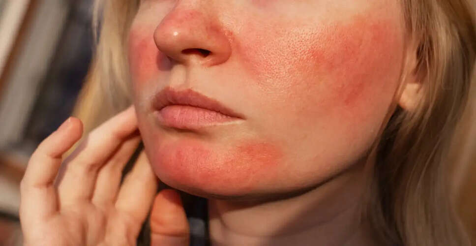 Effective Remedies to Alleviate Sunburn Pain and Promote Healing