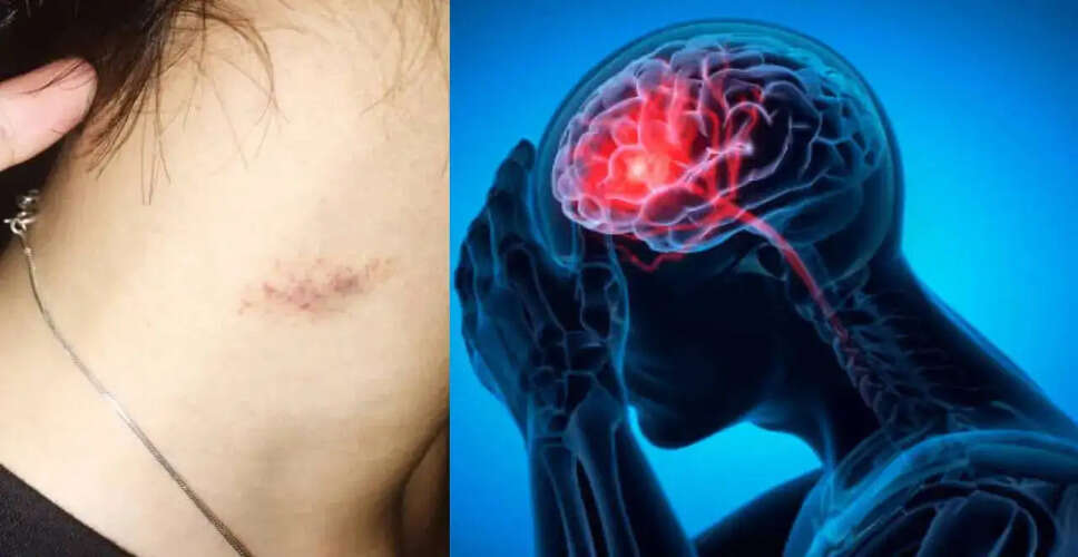 Teen's Fatal Stroke Linked to Hickey: A Rare Medical Case