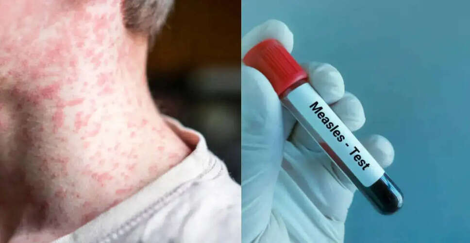 Surge in Measles Cases in the U.S. Raises Alarm Among Health Experts