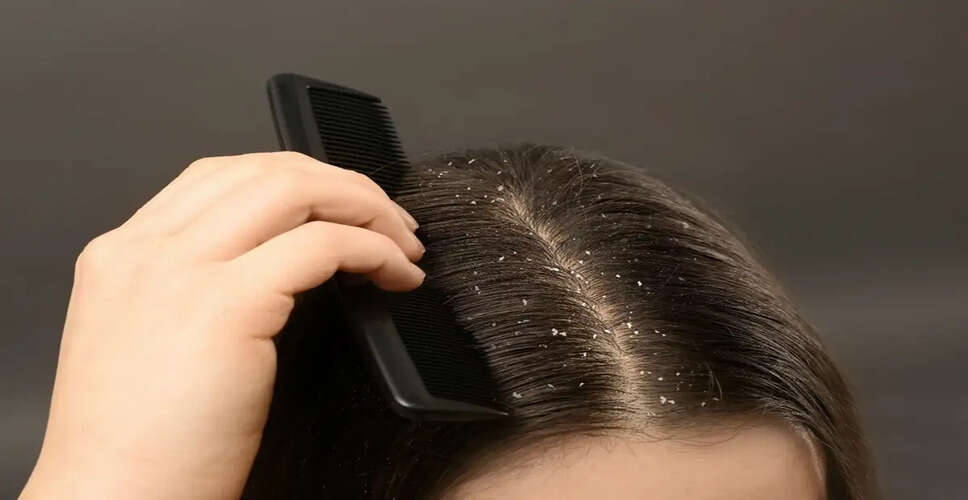 Effective Home Remedies to Combat Dandruff