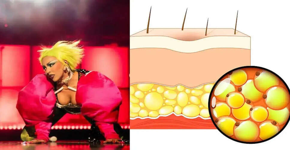 Doja Cat Brings Attention to Lipedema: Understanding the Condition