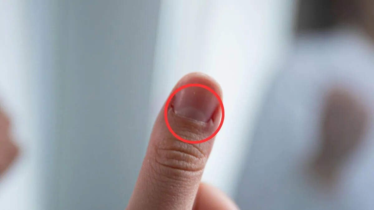 Understanding White Spots on Nails: Causes and Insights