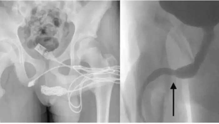 Young Man's Bizarre Incident Leads to Surgery After USB Cable Mishap