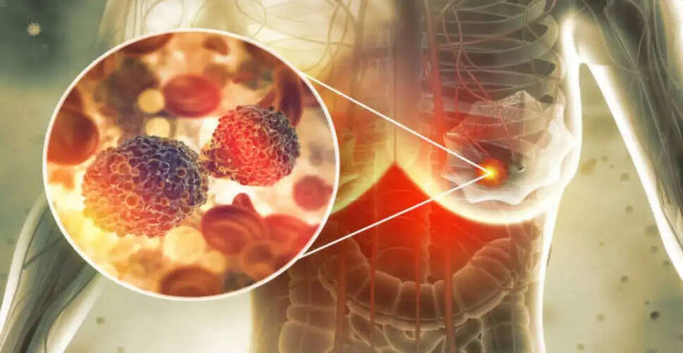 Surge in Breast Cancer Cases in Chennai: A Call for Awareness and Action