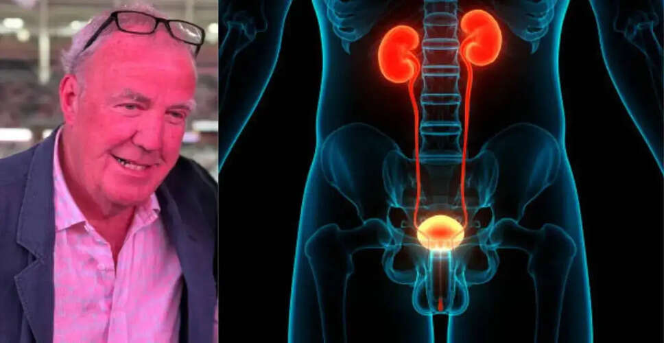 Jeremy Clarkson's Prostate Cancer Diagnosis Highlights Importance of Early Detection