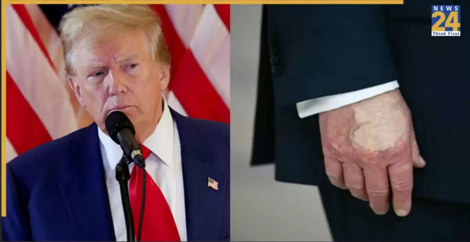 Trump's Hand Makeup Sparks Health Speculation During D.C. Visit