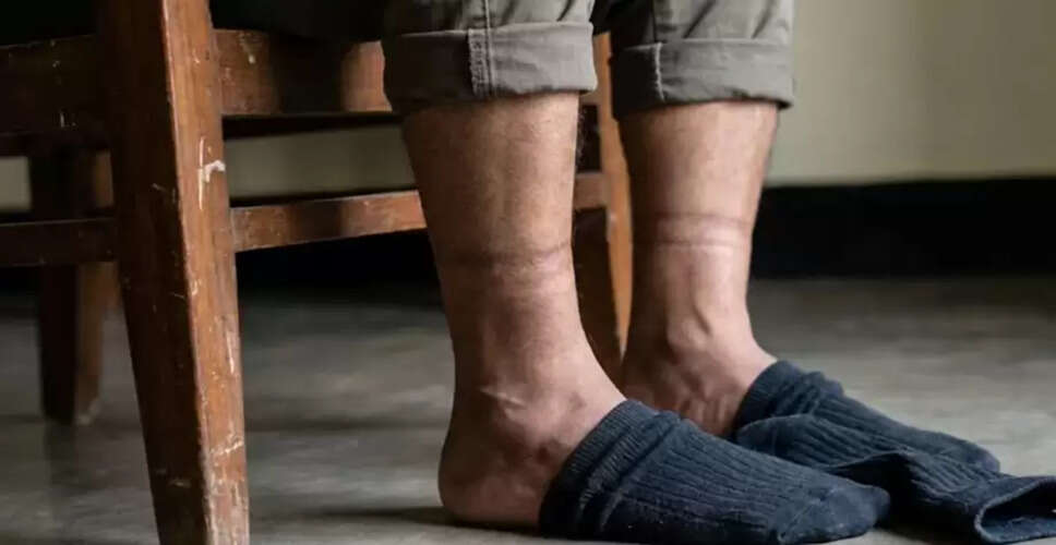 Understanding Sock Marks: When They Indicate Health Issues