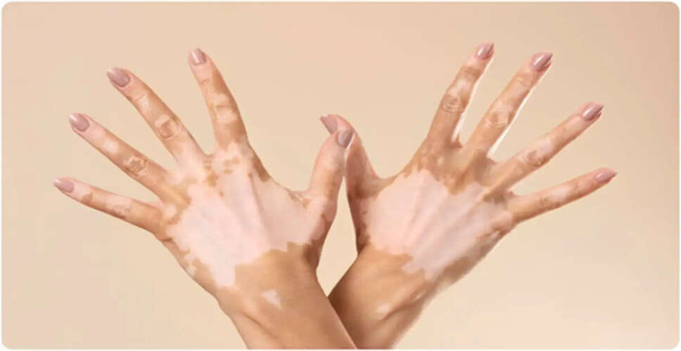 Understanding Vitiligo: Myths, Causes, and Treatment Options