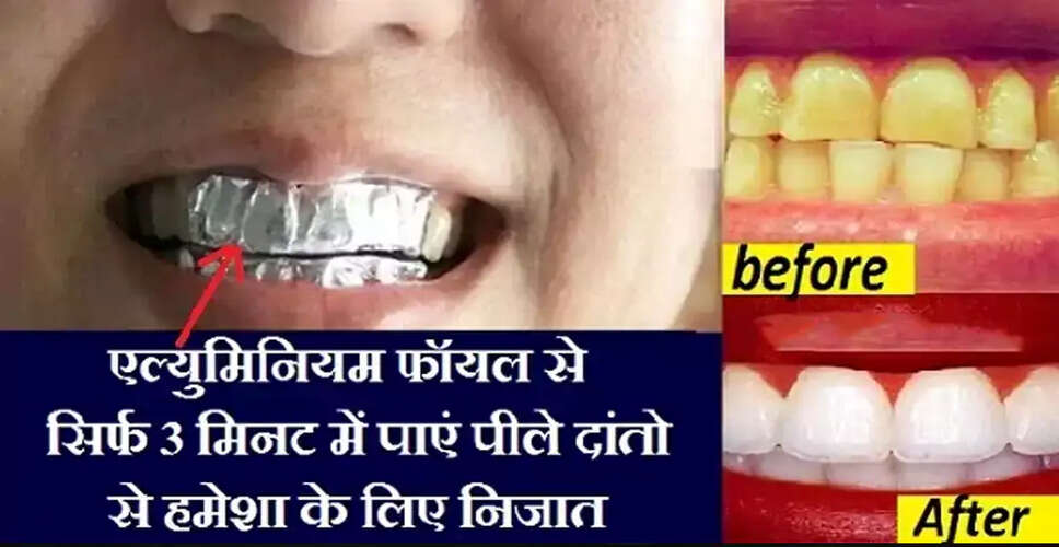 Effective Home Remedies for Whiter Teeth