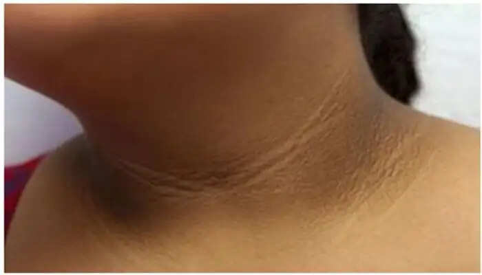 Understanding Childhood Obesity: Key Signs and Prevention Strategies