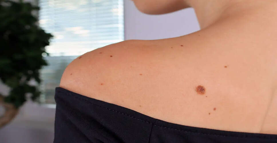 Understanding the Significance of Moles on Your Body