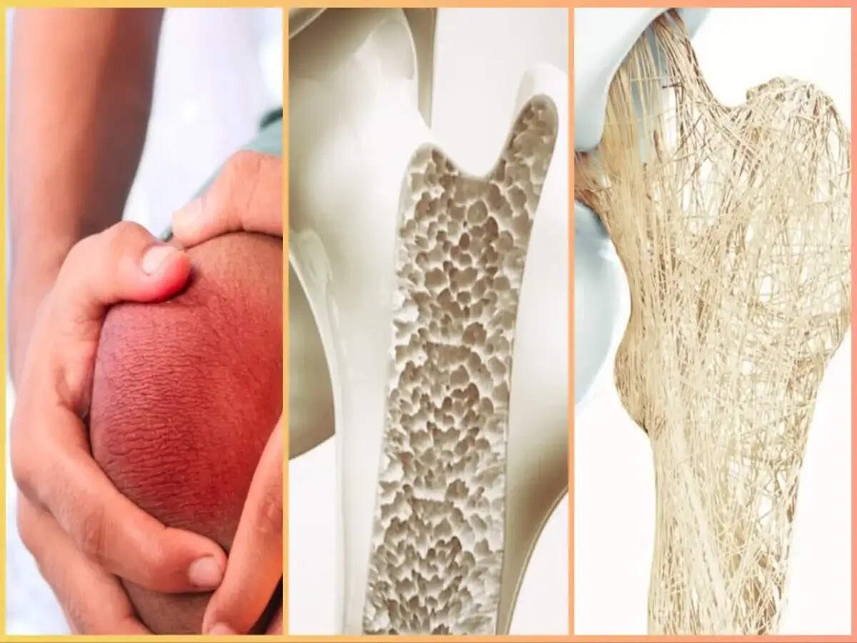 Understanding Osteoporosis: Risks, Symptoms, and Diagnosis