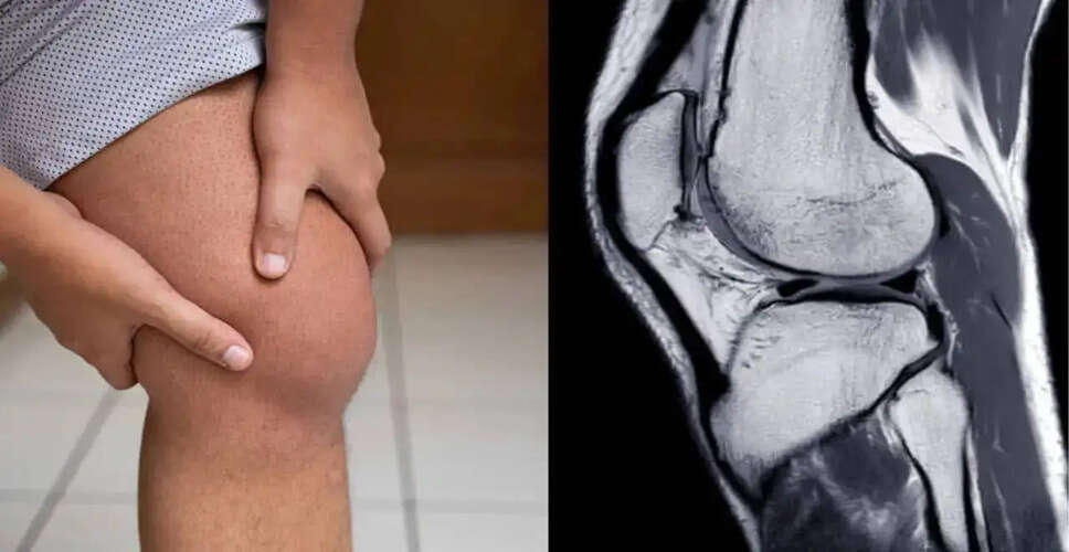 Understanding Knee Effusion: Causes, Symptoms, and Treatment