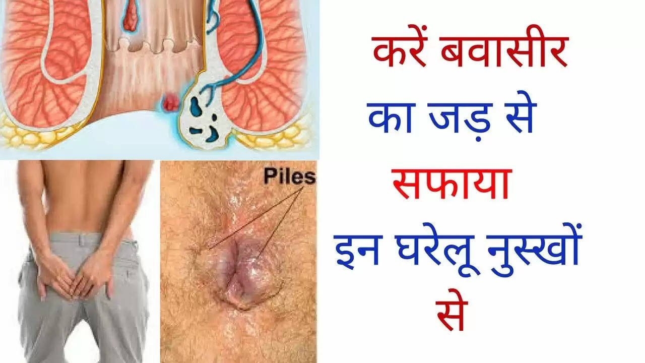 Understanding Hemorrhoids: Types, Symptoms, and Home Remedies