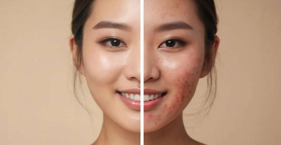 Effective Strategies to Combat Summer Acne
