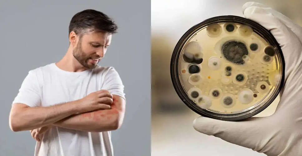 Emerging Threat: The Rise of Drug-Resistant Fungal Infections