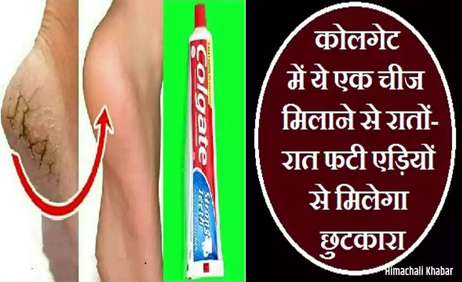 Effective Remedies for Cracked Heels: Achieve Soft Feet