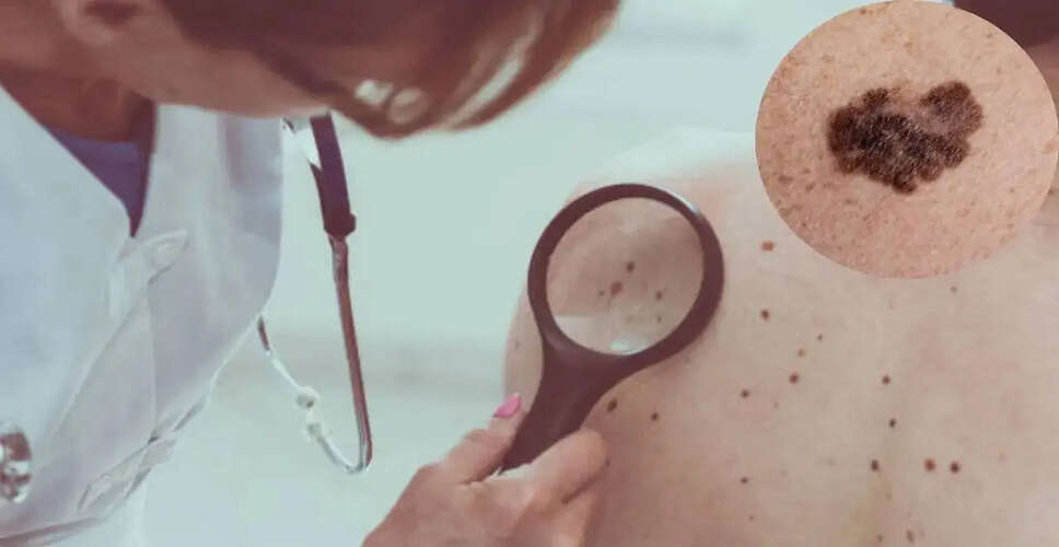 Surge in Melanoma Cases in the UK: Understanding the Risks and Prevention