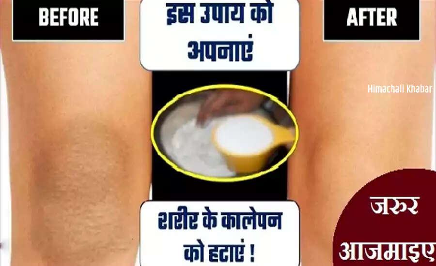 Effective Remedies to Lighten Dark Underarms, Elbows, and Knees