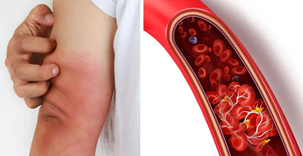 Recognizing the Silent Threat: 8 Symptoms of Blood Clots You Shouldn't Ignore