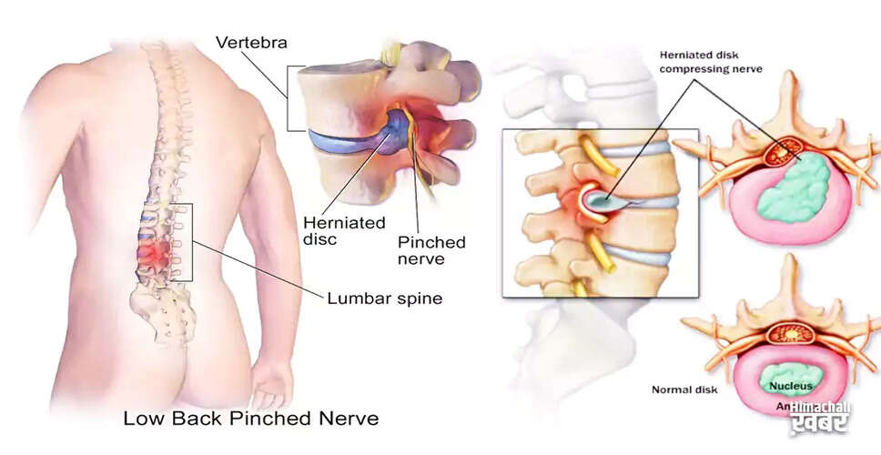 Effective Remedies for Relieving Back Pain