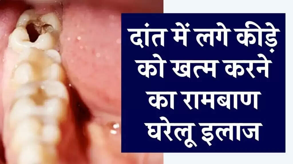 Effective Home Remedies to Treat Tooth Cavities