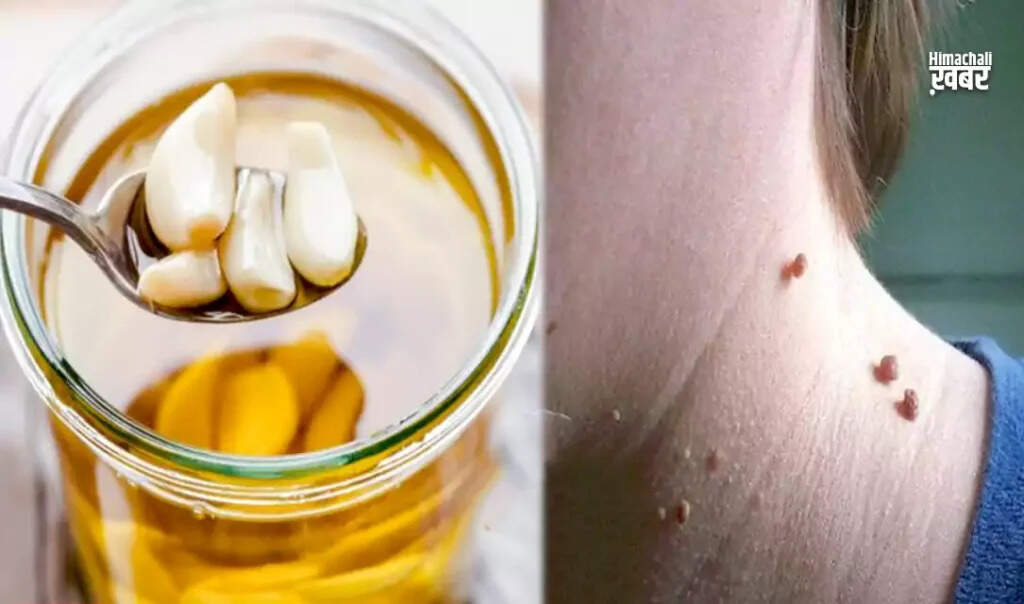 Effective Home Remedies to Remove Moles and Warts Naturally