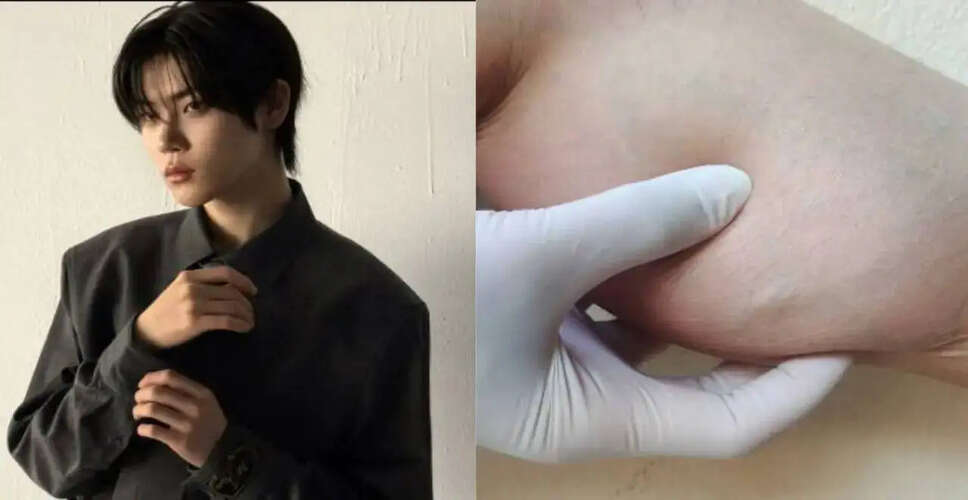 K-Pop Star Jang Yeojun Hospitalized Due to Rhabdomyolysis: Understanding the Condition