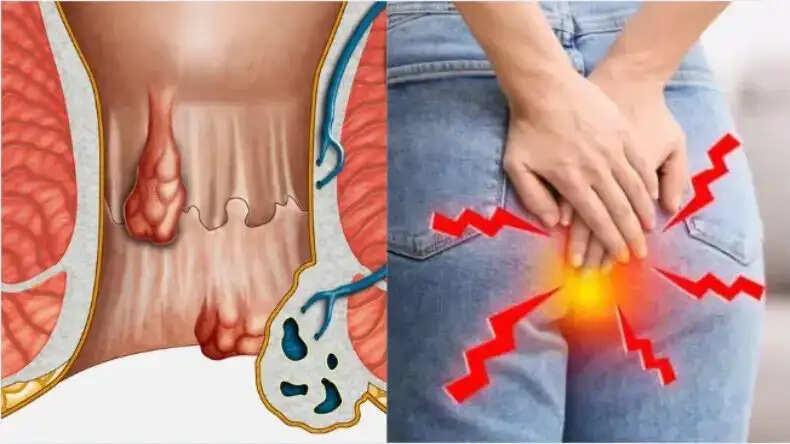 Effective Ayurvedic Remedies for Piles: Natural Solutions