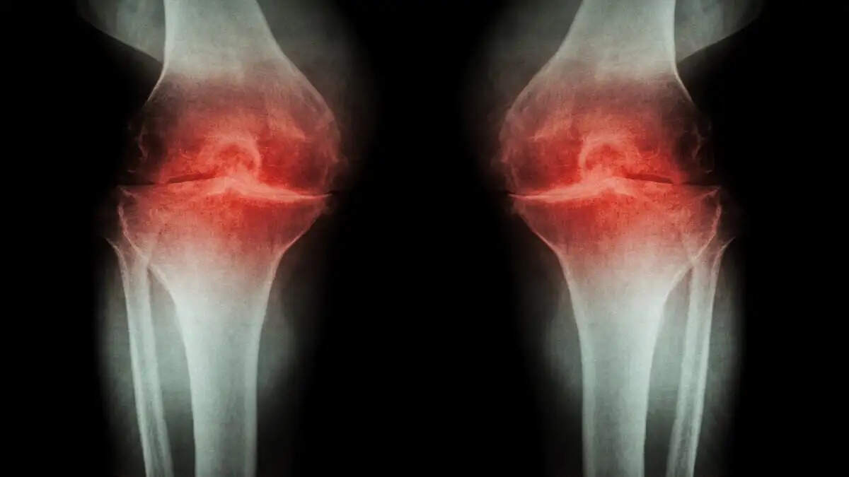 Stress and Anxiety: Hidden Threats to Bone Health