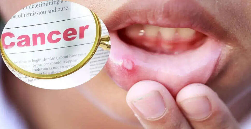 Understanding Mouth Ulcers: When to Seek Medical Attention