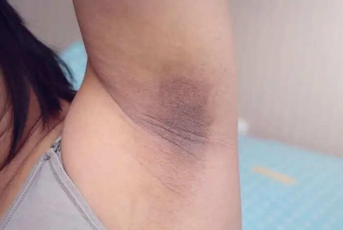Effective Remedies to Lighten Dark Underarms and Thighs