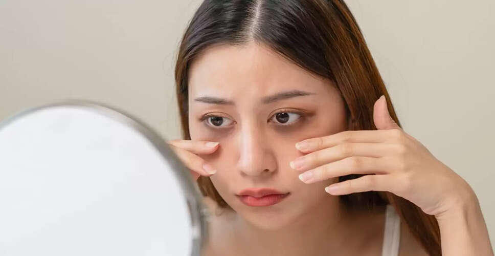 Effective Ways to Eliminate Dark Circles Naturally