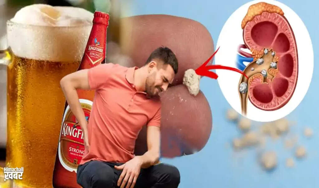 Can Beer Help in Passing Kidney Stones? Exploring the Truth