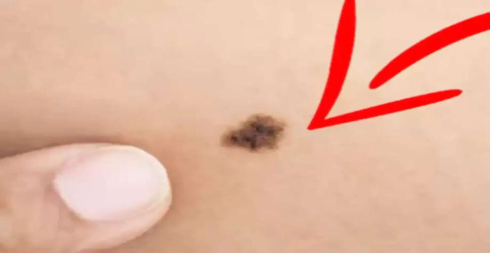 Astrology Insights: The Significance of Moles on Your Body