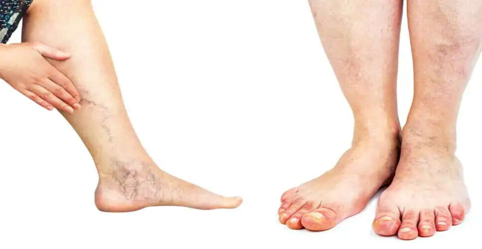 Understanding Muscle Cramps: Causes and Remedies