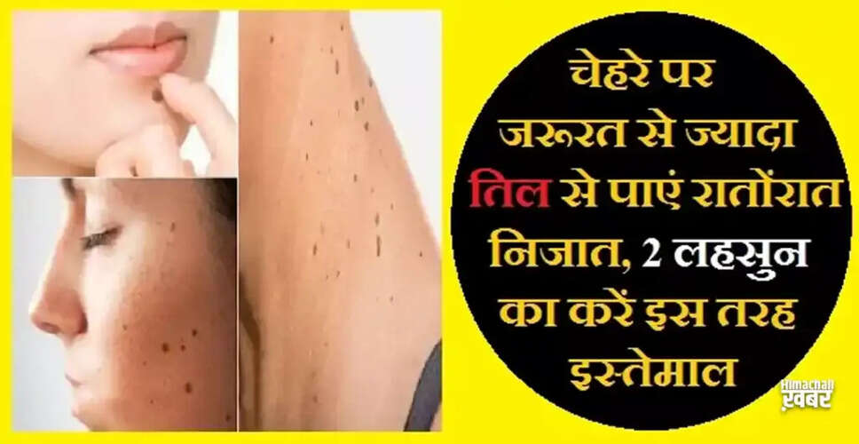 Effective Home Remedies to Remove Unwanted Moles