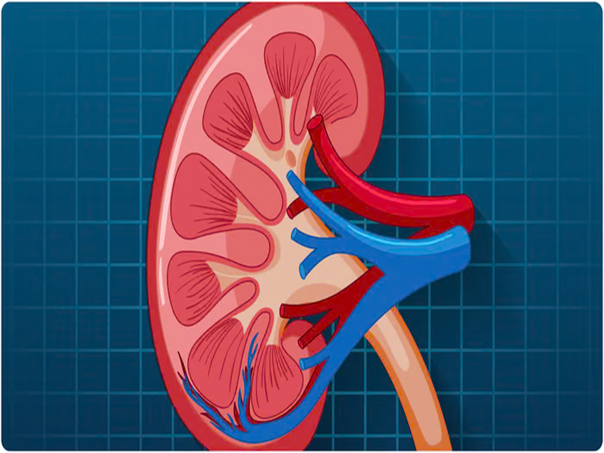 Comprehensive Guide to Kidney Stones: Understanding and Prevention
