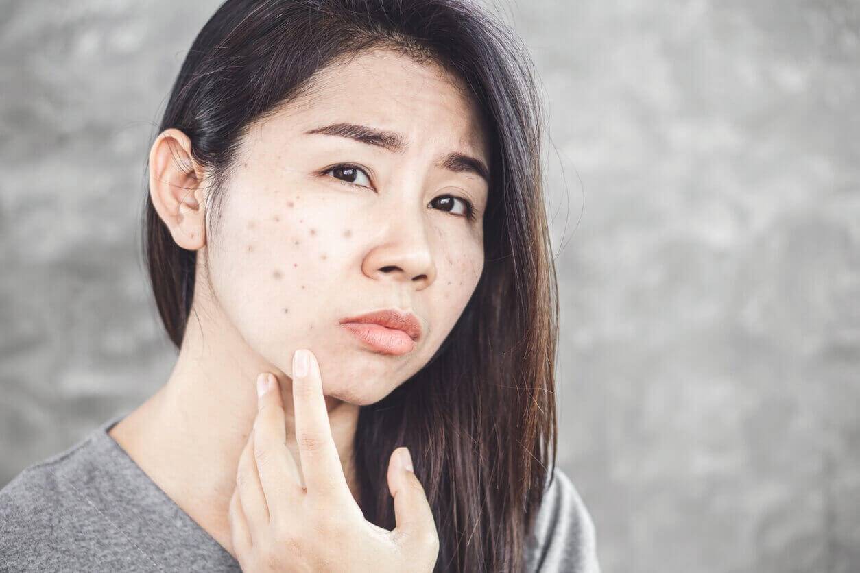 Banish Blemishes Naturally: Home Remedies to Fade Marks and Achieve Clearer Skin