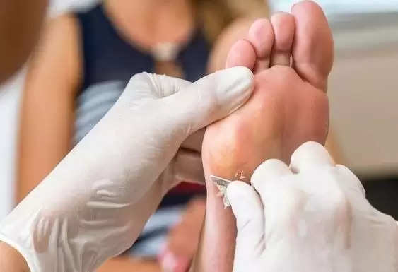 Callus-Free Feet: Say Goodbye to Rough Patches with These DIY Home Remedies